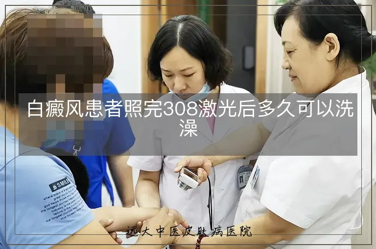 白癜风患者照完308激光后多久可以洗澡
