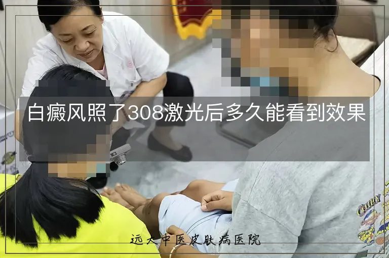 白癜风照了308激光后多久能看到效果