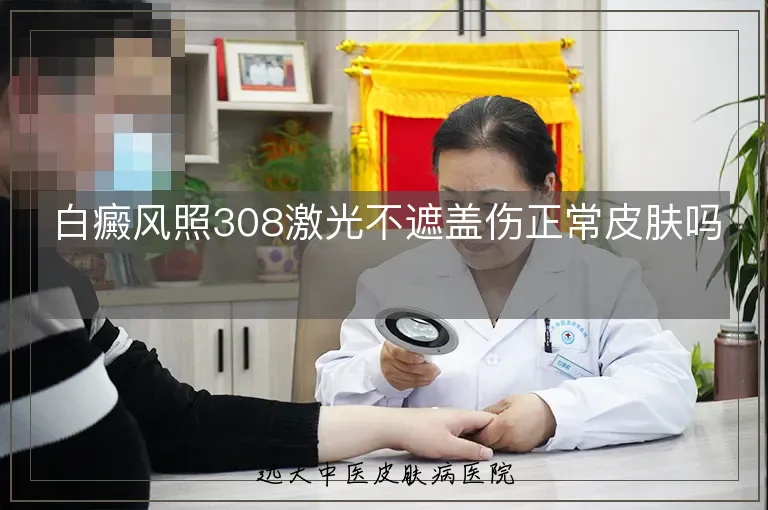 白癜风照308激光不遮盖伤正常皮肤吗