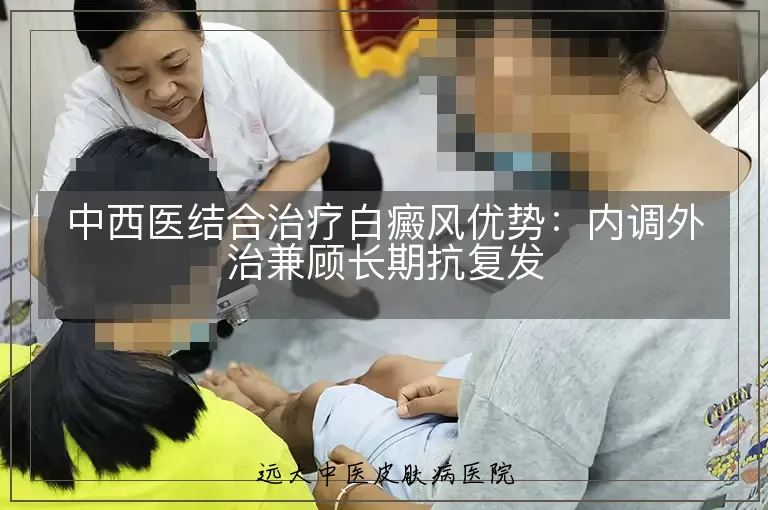 中西医结合治疗白癜风优势:内调外治兼顾长期抗复发