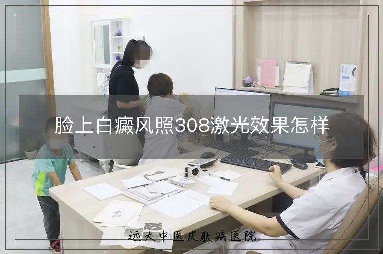 脸上白癜风照308激光效果怎样