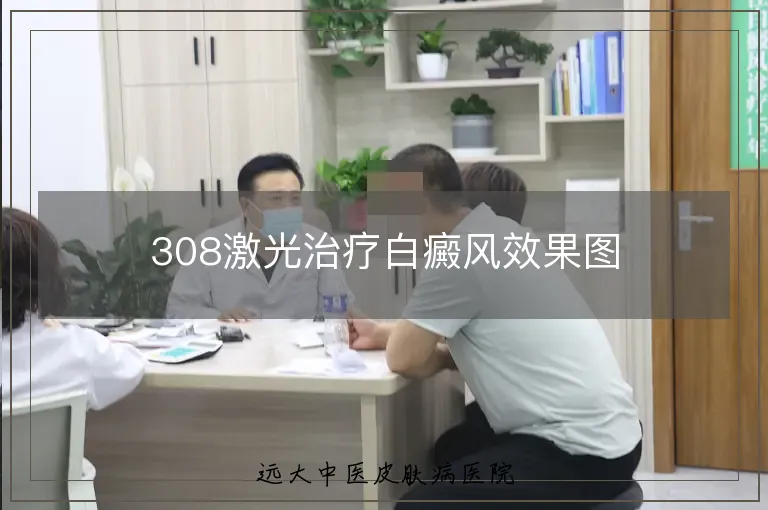 308激光治疗白癜风效果图