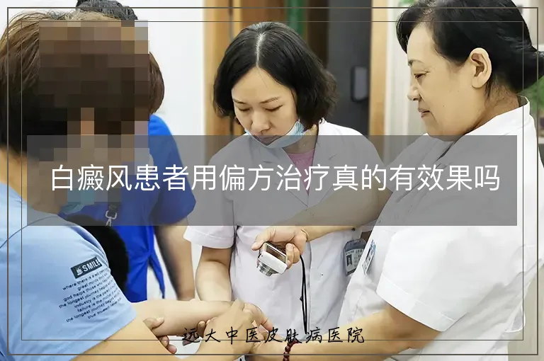 白癜风患者用偏方治疗真的有效果吗