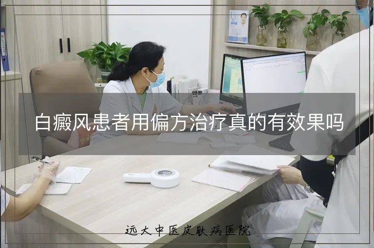 白癜风患者用偏方治疗真的有效果吗