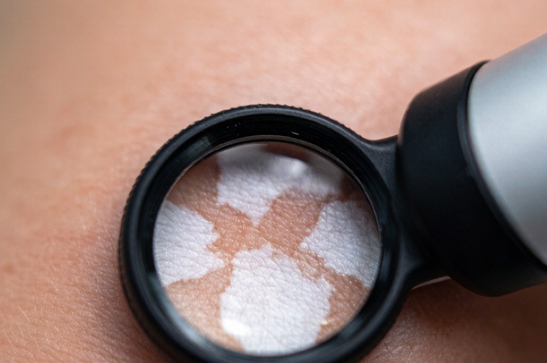 小孩得了白癜风怎么办,儿童白癜风治疗方法