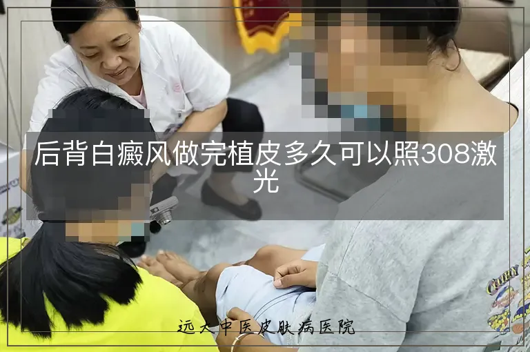 后背白癜风做完植皮多久可以照308激光
